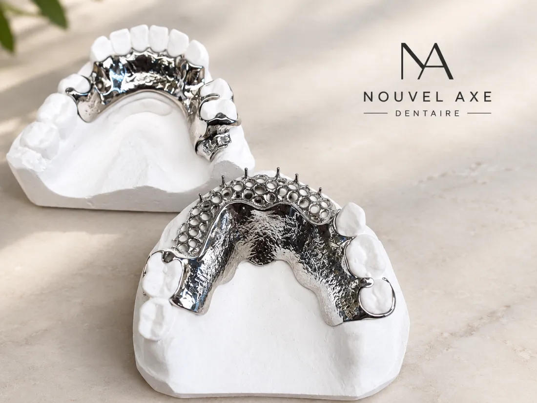 Deux châssis chrome-cobalt de prothèse partielle sur modèles en plâtre